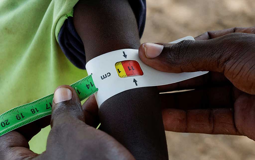 Peter Lokoyen, 4, is screened for malnutrition in Lomolem village, Turkana County, Kenya, Oct 29, 2025. REUTERS/Monicah Mwangi