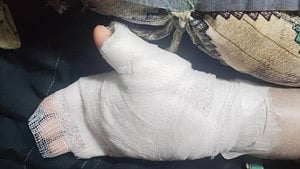 Tutor burns child’s hand in India for ‘bad handwriting’
