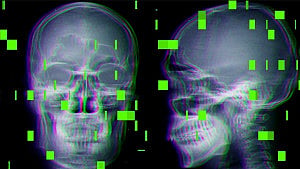 AI in operating rooms sparks reports of botched surgeries