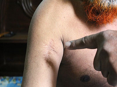 বীর প্রতীক মতিউর রহমানের হাতে আঘাতের চিহ্ন 
