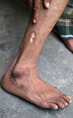 ডান পায়ে গুলির আঘাতের চিহ্ন 