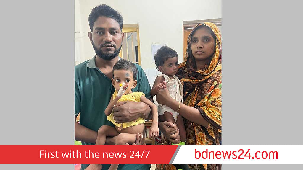 জোড়া লাগানো শিশু রিফা ও শিফা আলাদা জীবনে