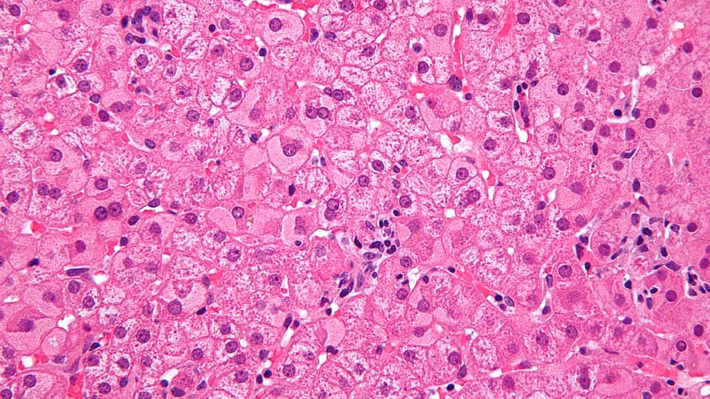 Bangladesh yet to roll out hepatitis birth dose